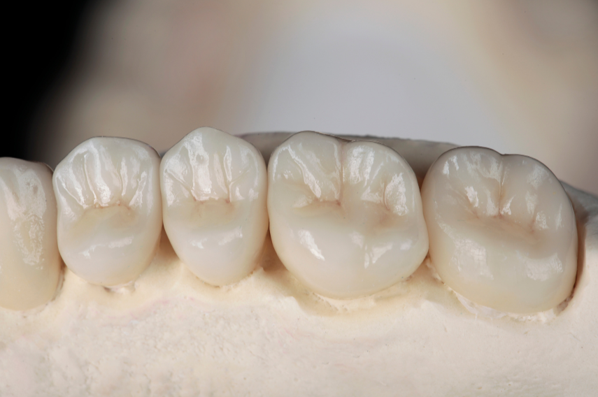 Everything You Need to Know About White Fillings